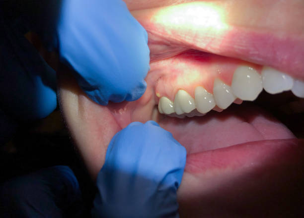 Best Emergency Dental Care for Broken or Chipped Teeth in Waycross, GA