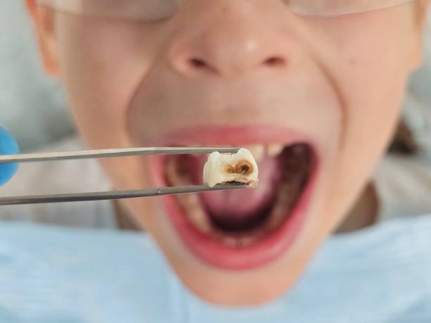 Best Emergency Root Canal Treatment in Waycross, GA